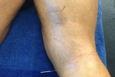 Dry Needling for Muscle Strains and Injury
