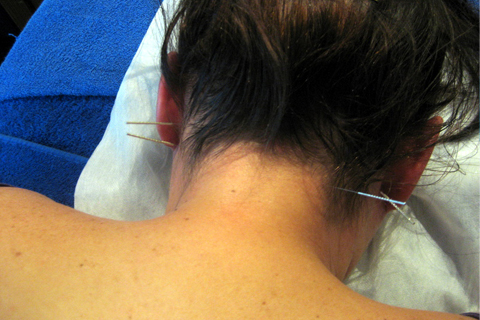 Dry Needling for headaches and neck pain relief