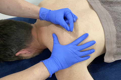 Dry Needling for Shoulder Pain and Injuries